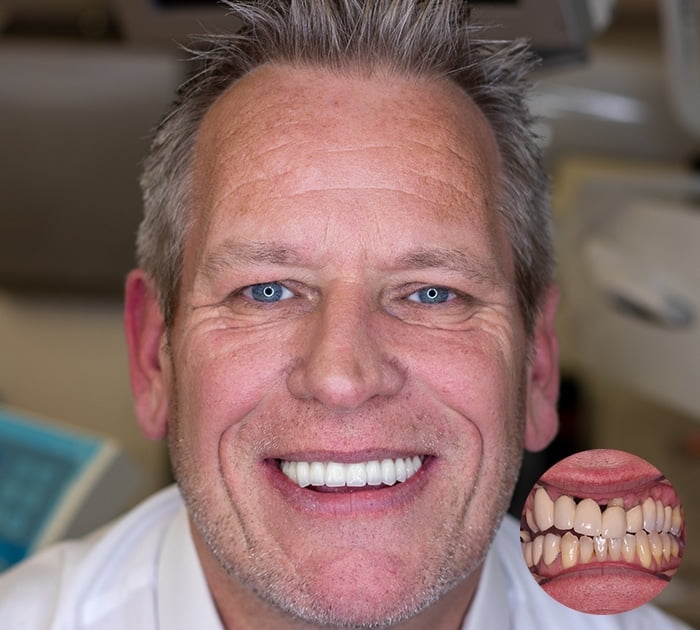 All your teeth replaced After having All your teeth replaced treatment
