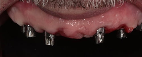 Full arch digitally designed temporary bridge1