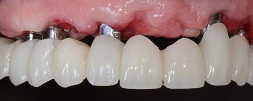 Full arch digitally designed temporary bridge2