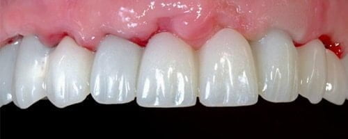 Full arch digitally designed temporary bridge3