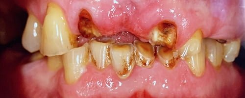 Full arch digitally designed temporary bridge4