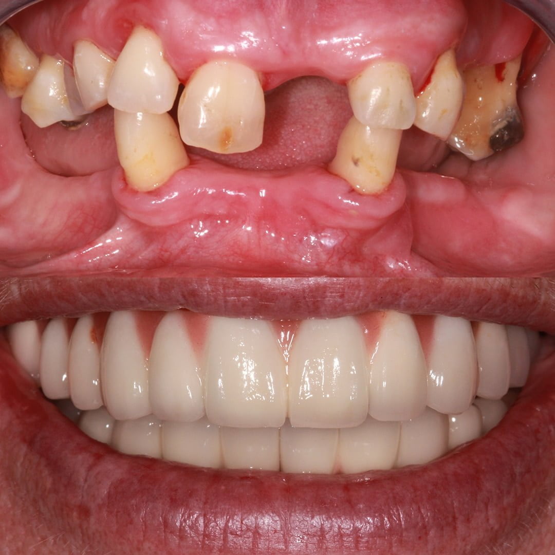 full-set-of-teeth-reading-1