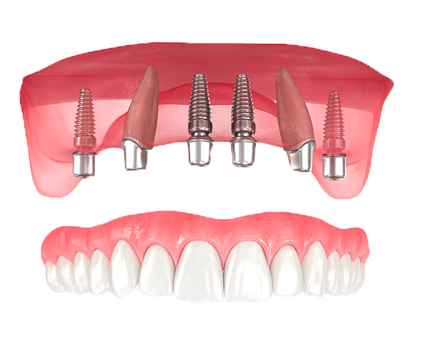 implants All on 4 treatment Birmingham