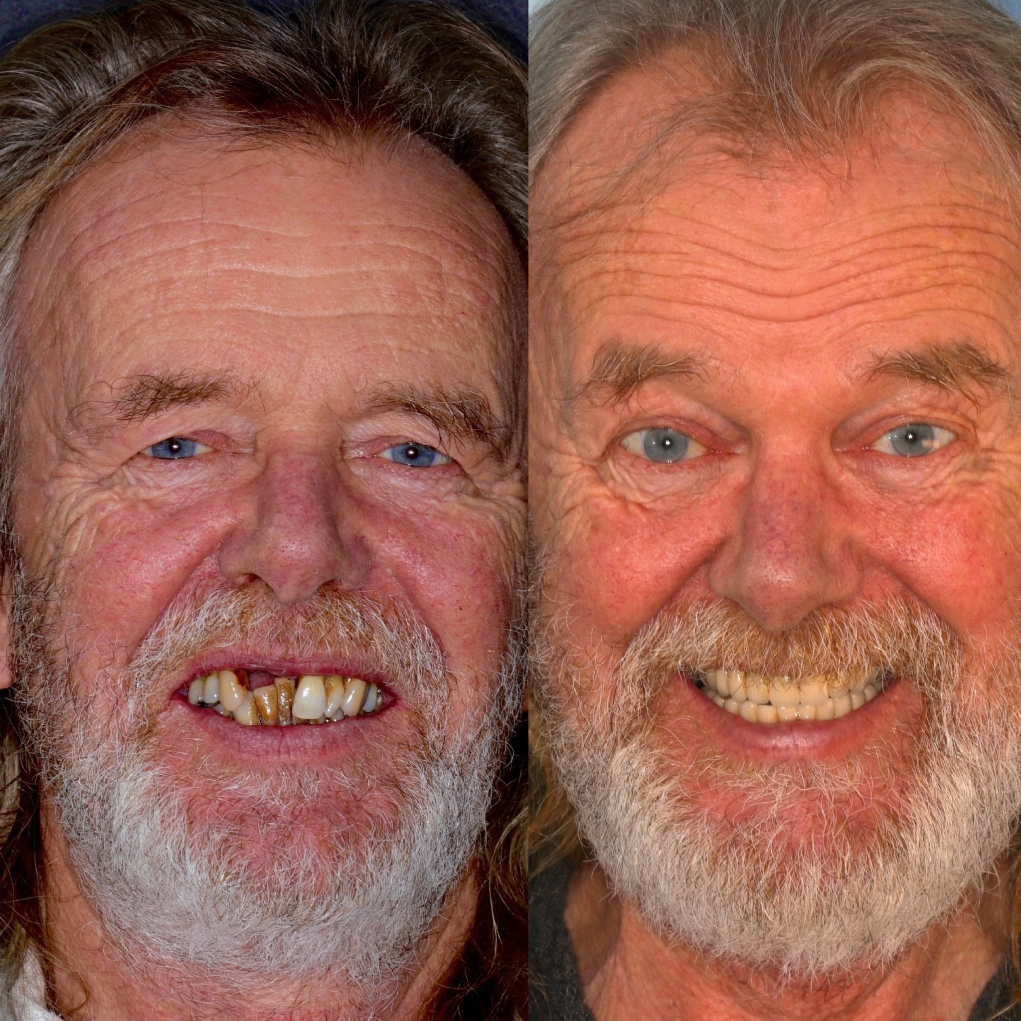 dental-implants-full-mouth