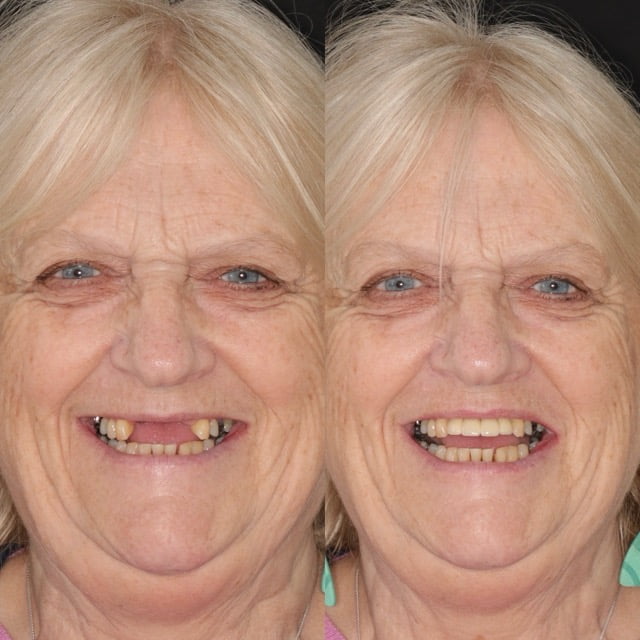 dental-implant-reading