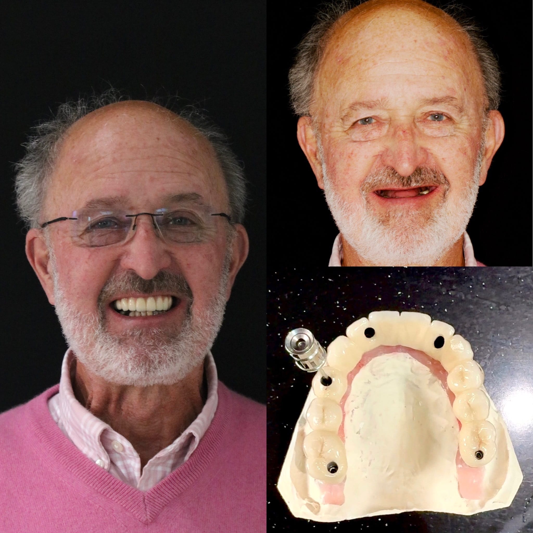 full-mouth-dental-implant