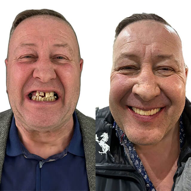 dental-implant-before-after-image