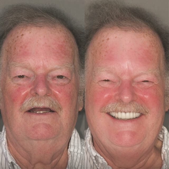 dental-implant-before-after