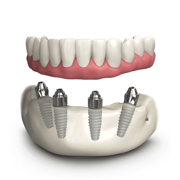 dental-implants